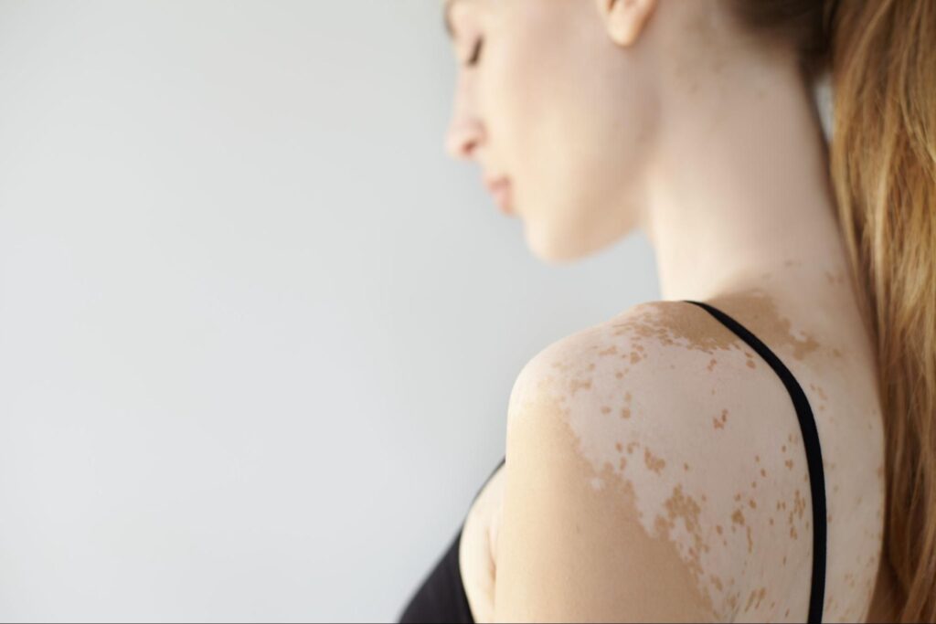 white-spots-on-skin-after-swimming-causes-and-remedies-99glamour