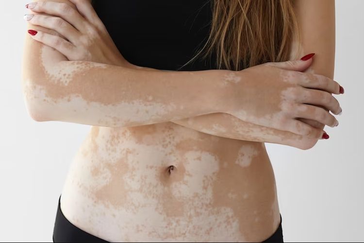 white-spots-on-skin-after-swimming-causes-and-remedies-99glamour